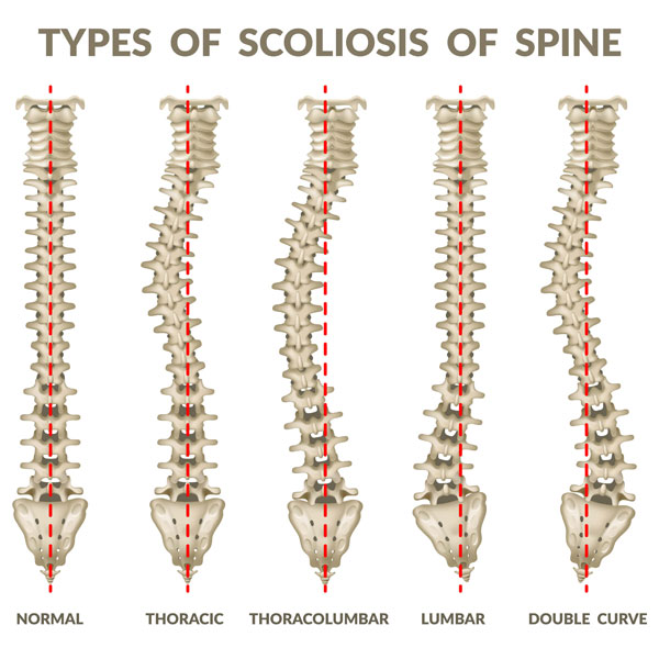 types-of-scoliosis-of-pine